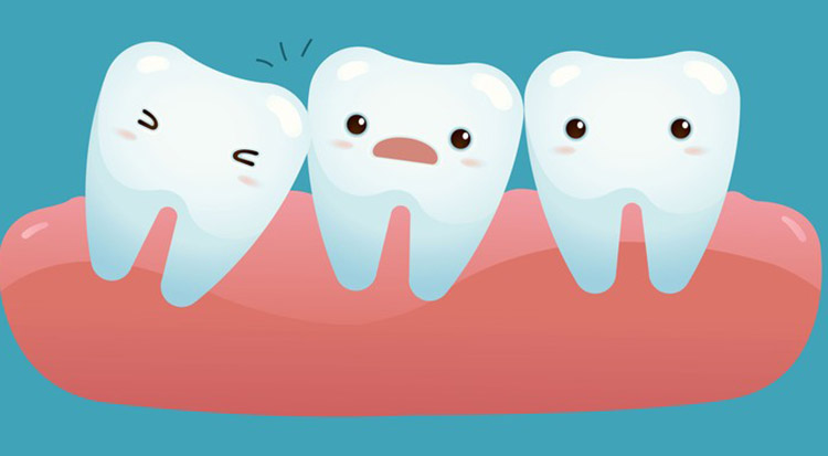Wisdom Teeth Extraction in Adelaide